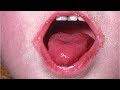 What Is Scarlet Fever