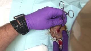 Re-TREATED ABSCESS!  STILL INFECTED.  INCISION / DRAINAGE AND PACKING