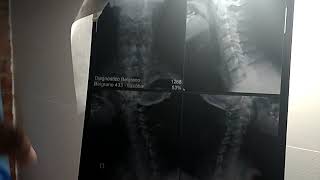 Como Corregí la Rectificación Cervical con Yoga y Osteopatía