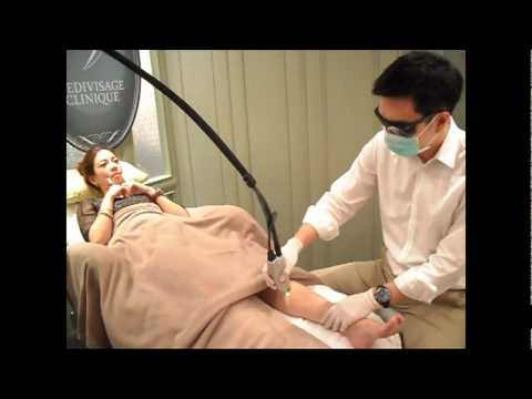 Hair Removal by GentleYAG