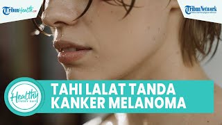 Hati-hati! Tahi Lalat pada Tubuh Bisa Jadi Tanda Kanker Melanoma, Begini Gejala dan Cara Mengobati