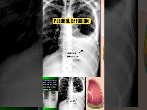 🚨Chest X-Ray Findings in Pneumonia with Pleural Effusion 🩻 #shorts #radiology #chest #doctor