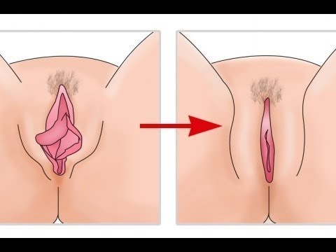 Is Vaginal Discharge Normal