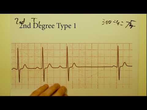 ECG/EKG interpretation (basics) COURSE Part 3 of 3 ~ Heart Block Analysis