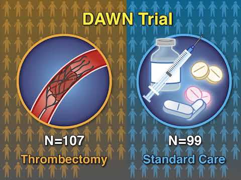 脳卒中のアウトカムの改善 (Improving Outcomes in Stroke)