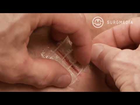 When You Can't StItch It, ZIp It: Suture-Less Bandage to Close Wounds