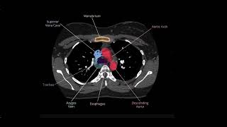 Chest Anatomy on actual CT Scan Simplified with Labels | Radiology Illustration