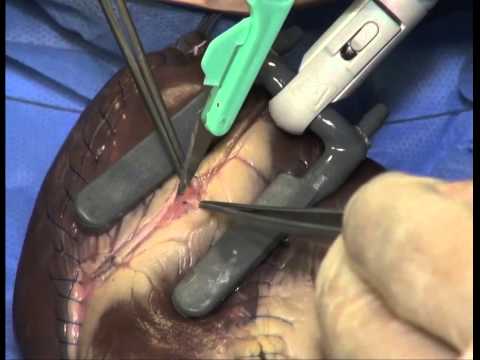 Occlusione in gola quando losteocondrosi cervicale PMP nelle fratture del rachide cervicale