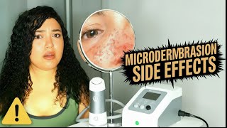 Microdermoabrasión : EFECTOS SECUNDARIOS - PIEL DESPUÉS DE LA MICRODERMOABRASIÓN CASERA y CABINA