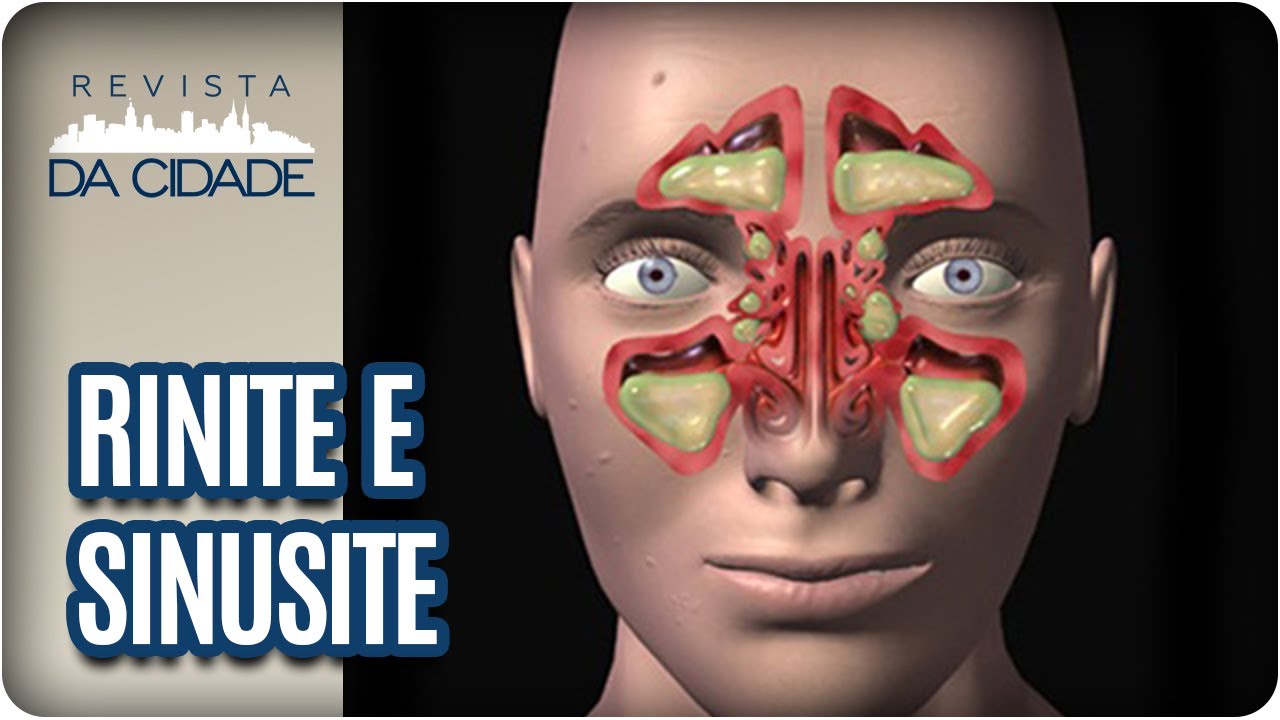 Doenças Respiratórias: Rinite e Sinusite - Revista da Cidade (05/07/17)