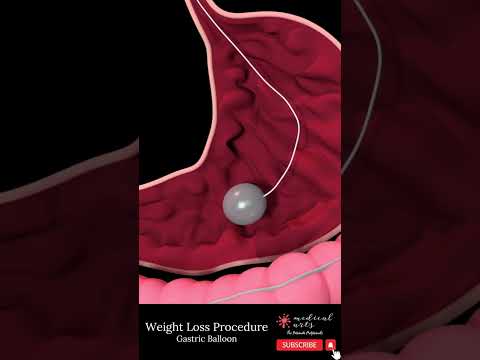 GASTRIC BALLOON [] bariatric surgery [] weight loss surgery #shorts