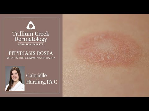 What is Pityriasis Rosea?