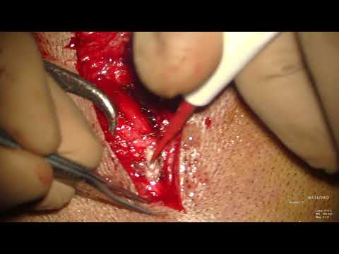 Superficial Temporal Artery Harvesting for STA-MCA bypass
