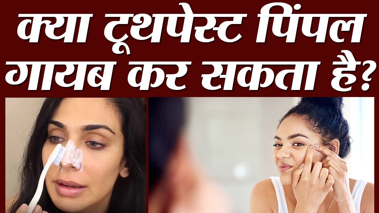 Watch video क्या Pimple पर Toothpaste लगाना चाहिए Now क्या Pimple पर Toothpaste लगाना चाहिए