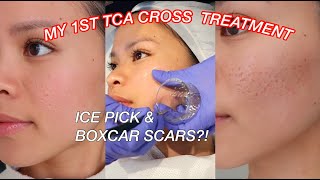TCA CROSS FOR ACNE SCARS l Ice pick & Boxcar scars on Asian Skin