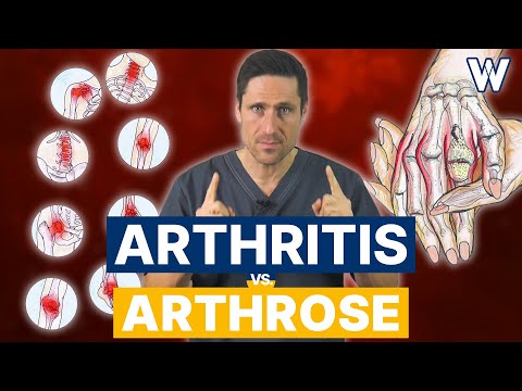 Arthrose vs. Arthritis: Gibts Unterschiede? Ursachen und Therapien von Gelenkschmerzen