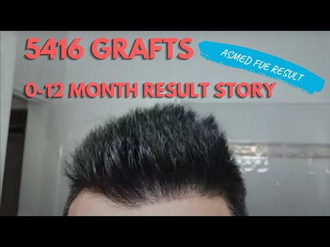 download lagu mp3 mp4 Asmed Hair Transplant Center Istanbul Turkey, download lagu Asmed Hair Transplant Center Istanbul Turkey gratis, unduh video klip Asmed Hair Transplant Center Istanbul Turkey