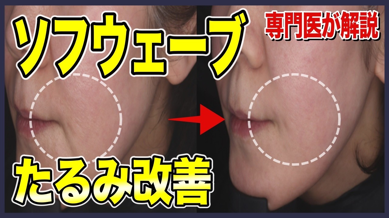 ソフウェーブについて医師が解説