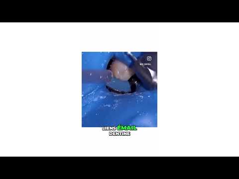 Astuce digue liquide pour composite – Restauration