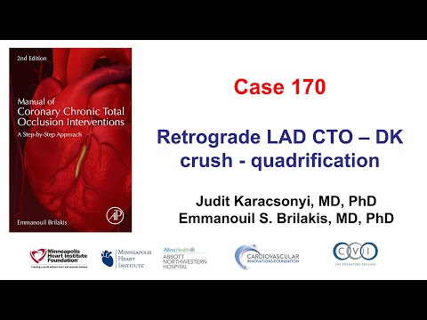 Case 170: Manual of CTO PCI - Retrograde LAD CTO PCI and DK crush for quadrification