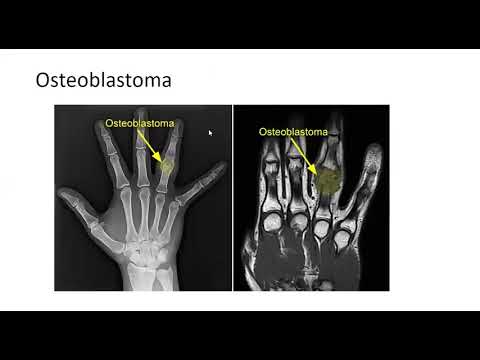Osteoblastoma