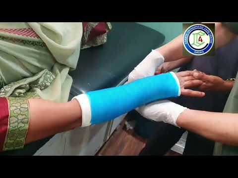 Undisplaced fracture Lower end Radius | Closed reduction fracture | Fiberglass plastering | Adamya H