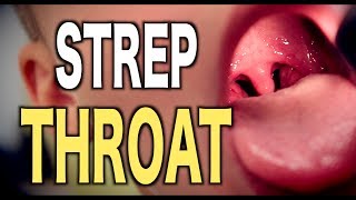 Strep Throat: LIVE DIAGNOSIS