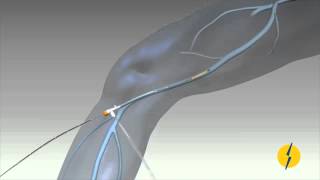 Ablación por radiofrecuencia de la safena interna