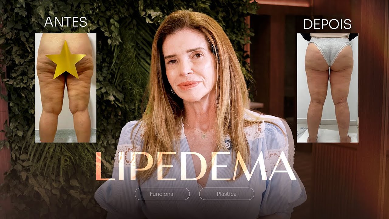 Lipedema na barriga: Causas, Sintomas e Tratamento