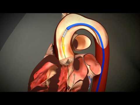 Transcatheter Aortic Valve Replacement (TAVR)  animation