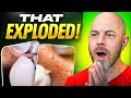 Dermatologist Reviews TikTok S Most Viral Pimple Pops