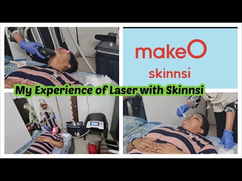 Lazer Hair Removal face | My Experience| Reviews of Skinssi