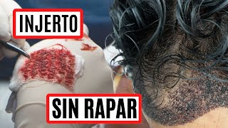 Injerto Capilar sin rapar la cabeza 💯 ¡ES POSIBLE! 🔝
