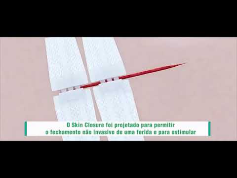 Curativo MEM Cirúrgica Skin Closure Ponto Falso para Fechamento de Feridas