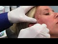 Temple Filler with Restylane Defyne + Cannulas by Dr. Weiner