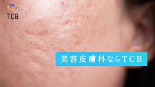 CM「TCBのニキビ跡・クレーター治療」