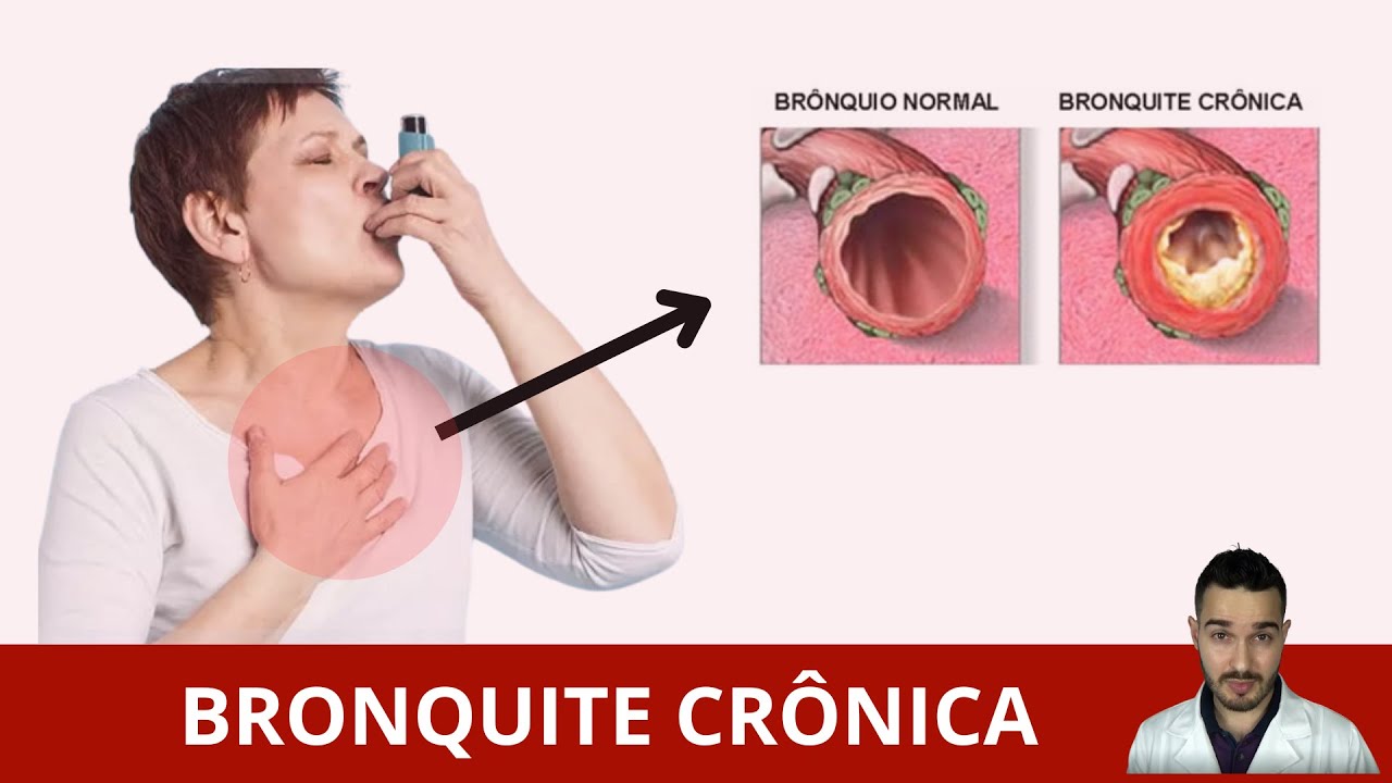 [TUDO-SOBRE] BRONQUITE CRÔNICA