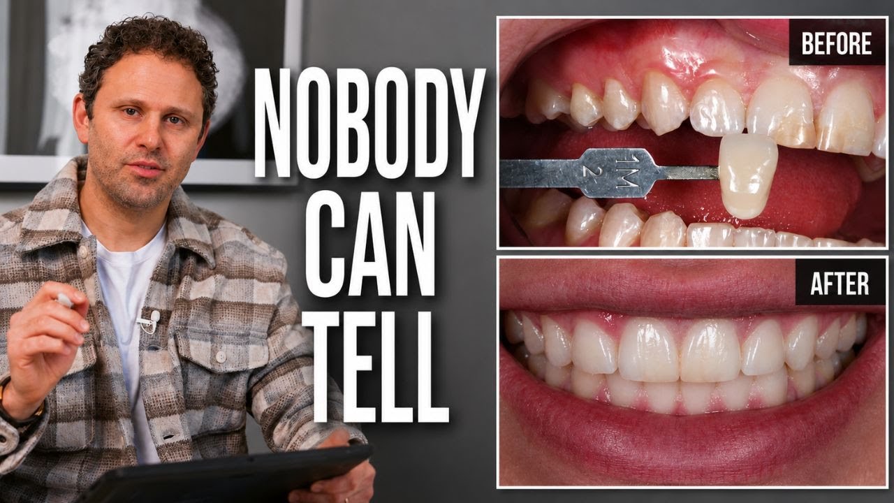 How We Matched Porcelain Veneers to Natural Teeth