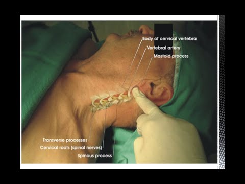 Insights On Performing Cervical Plexus Block