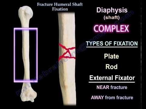 Humeral Shaft fracture  Fixation - Everything You Need To Know - Dr. Nabil Ebraheim