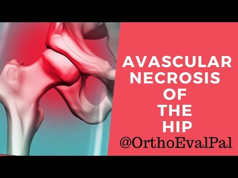 Avascular Necrosis of the Hip:Explained by Paul at Ortho Eval Pal