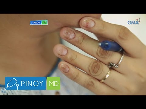 Ekzoderil hindi makakatulong kung ano ang gagawin Kung paano kumuha Irunine sa paa halamang-singaw