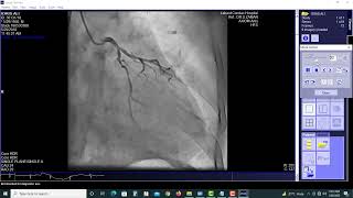 Coronary Angiography Test Video