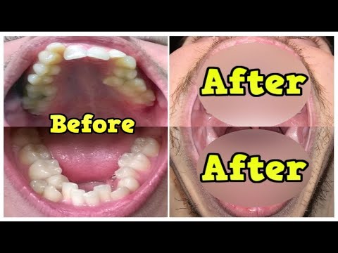 download lagu mp3 mp4 Teeth Braces Before And After Pictures, download lagu Teeth Braces Before And After Pictures gratis, unduh video klip Teeth Braces Before And After Pictures