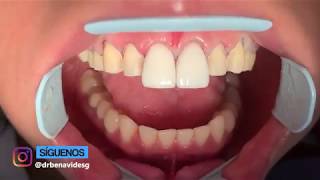 Carillas Dentales I ¿Qué Color Elegir