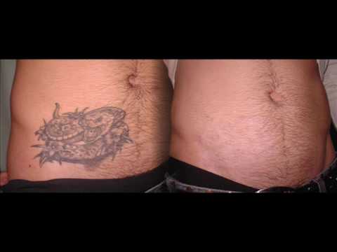 Siccome è possibile togliere posti di pigmentary Decolorazione di creme Ucraina