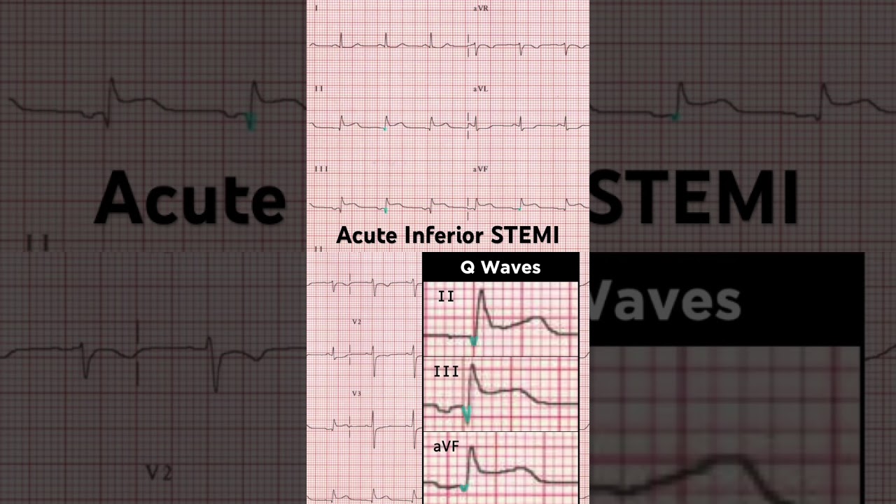 Acute Inferior ST elevation myocardial infarction (STEMI) ECG: Pathological Q waves