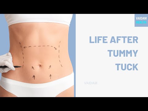 Life after Tummy Tuck