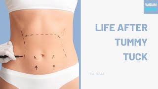 Life after Tummy Tuck