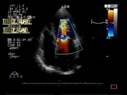 Mitral Stenosis In Different Aspects: Mitral Stenosis With Leaflets Borders Calcification